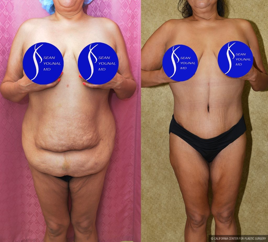 Tummy Tuck (Abdominoplasty) Plus Size Before & After Patient #13874