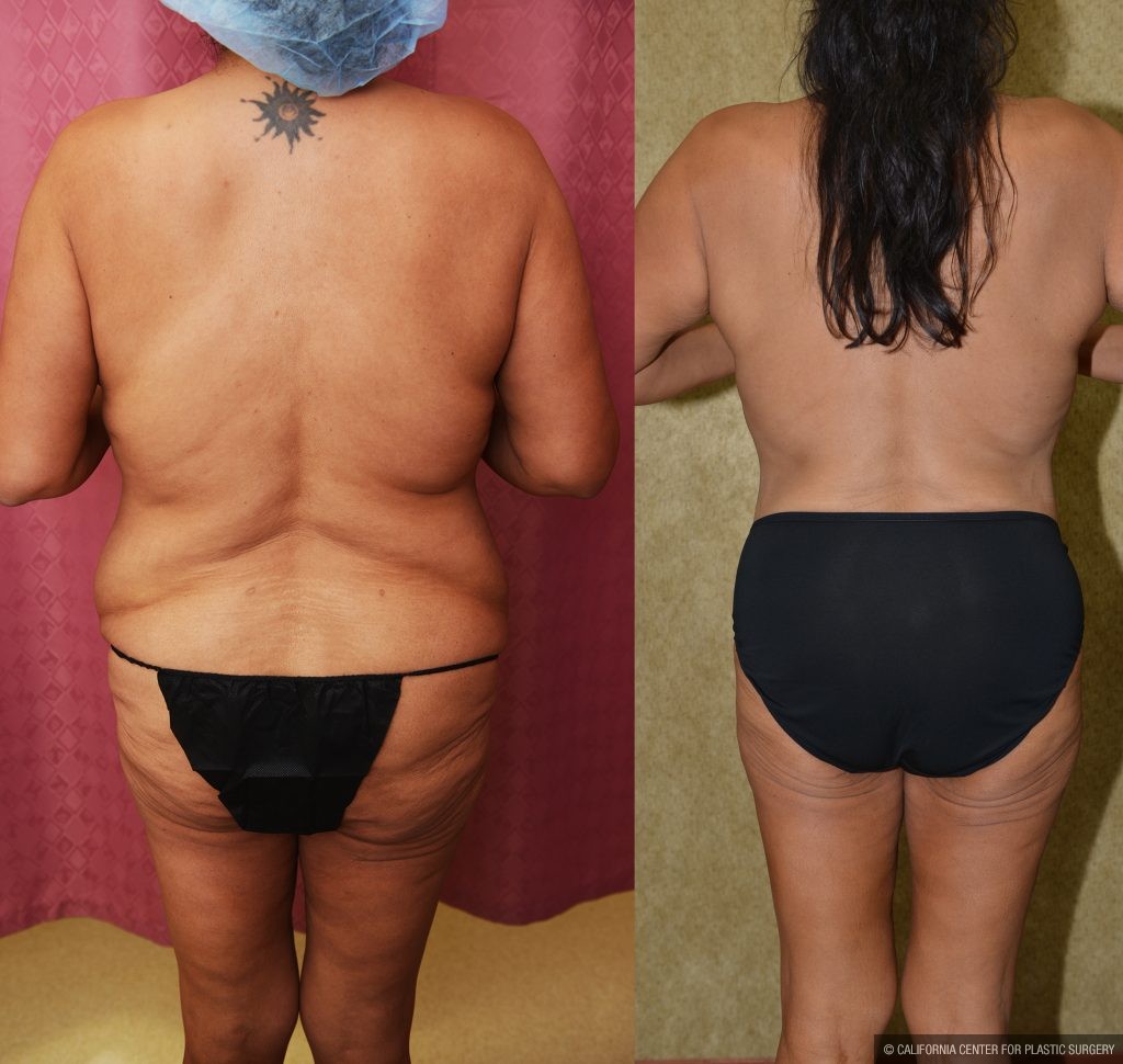 Tummy Tuck (Abdominoplasty) Plus Size Before & After Patient #13874