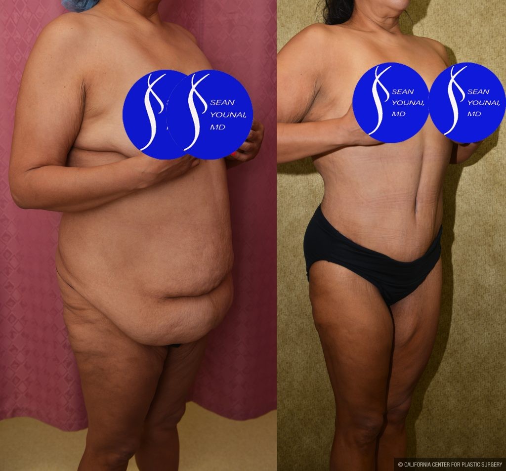 Tummy Tuck (Abdominoplasty) Plus Size Before & After Patient #13874