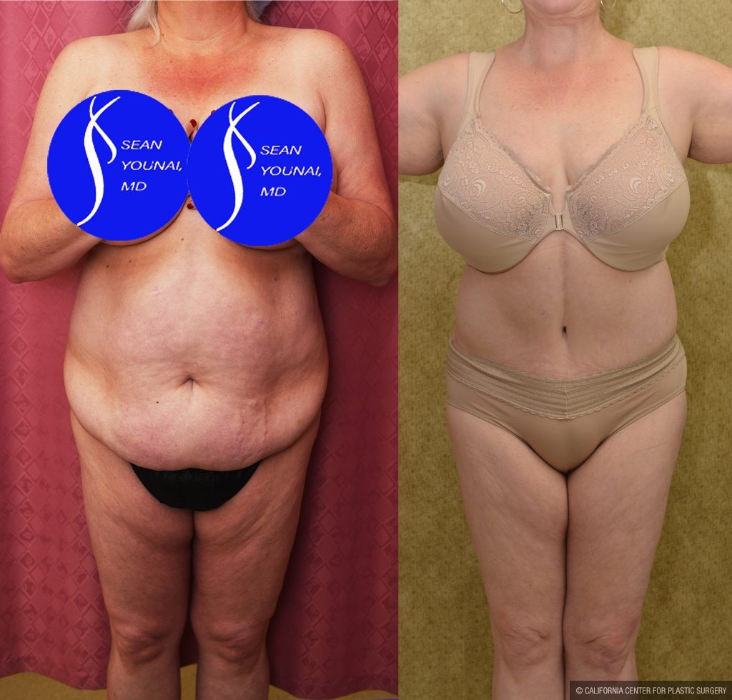 Tummy Tuck (Abdominoplasty) Plus Size Before & After Patient #13875