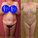 Tummy Tuck (Abdominoplasty) Plus Size Before & After Patient #13875