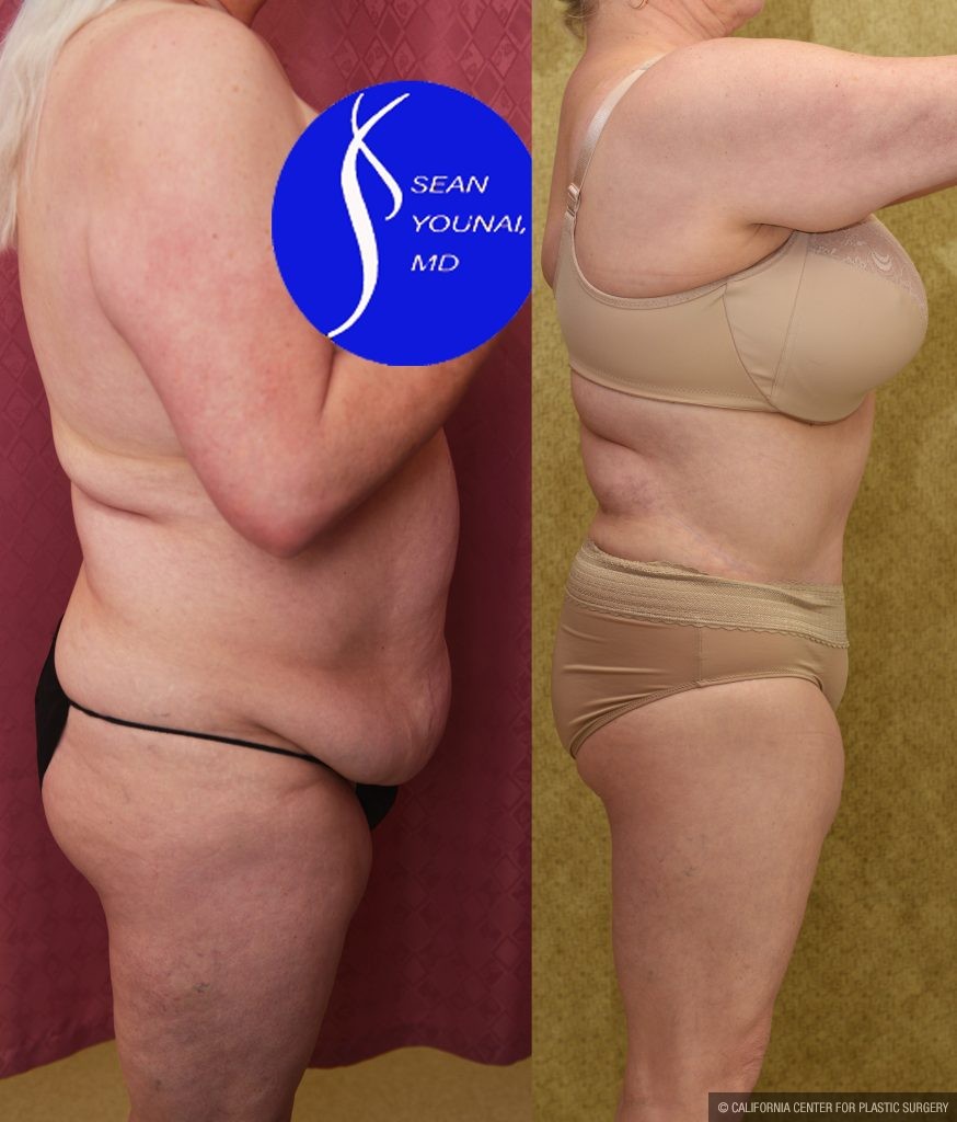 Tummy Tuck (Abdominoplasty) Plus Size Before & After Patient #13875