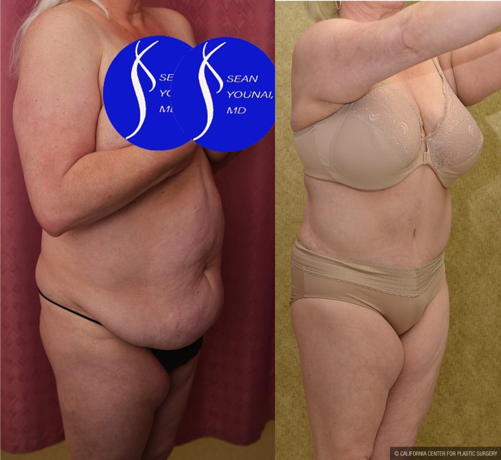 Tummy Tuck (Abdominoplasty) Plus Size Before & After Patient #13875