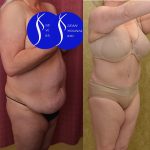 Tummy Tuck (Abdominoplasty) Plus Size Before & After Patient #13875
