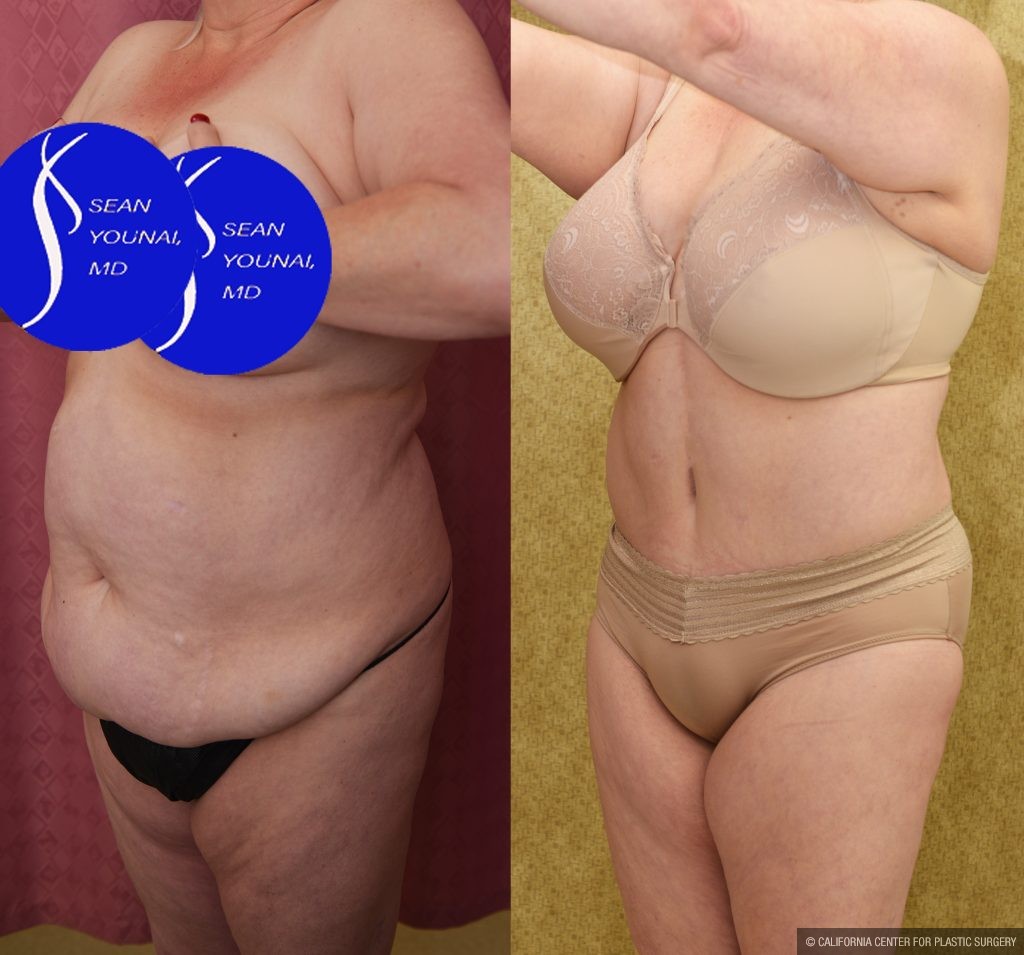 Tummy Tuck (Abdominoplasty) Plus Size Before & After Patient #13875