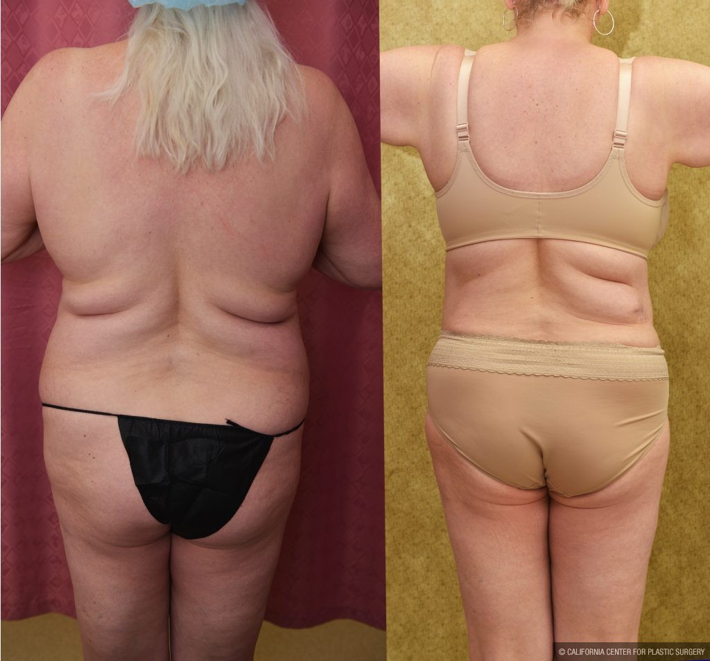 Tummy Tuck (Abdominoplasty) Plus Size Before & After Patient #13875