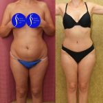 Tummy Tuck (Abdominoplasty) Small Size Before & After Patient #13878