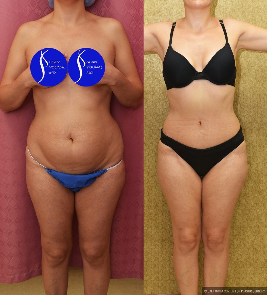 Tummy Tuck (Abdominoplasty) Small Size Before & After Patient #13878