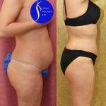 Tummy Tuck (Abdominoplasty) Small Size Before & After Patient #13878