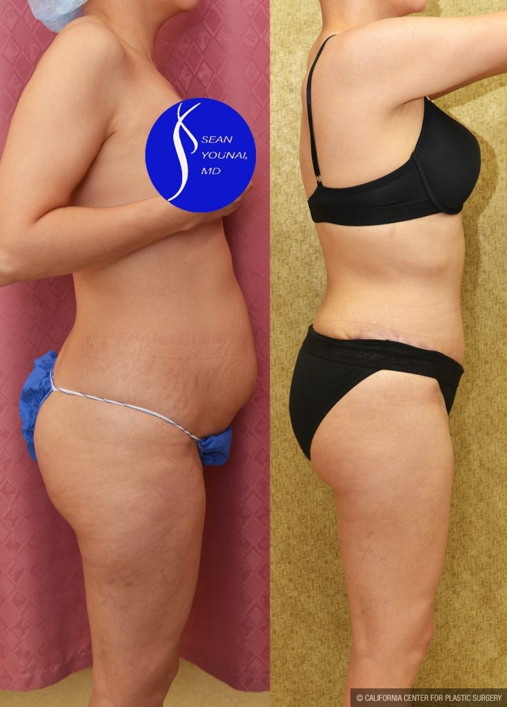 Tummy Tuck (Abdominoplasty) Small Size Before & After Patient #13878