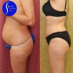 Tummy Tuck (Abdominoplasty) Small Size Before & After Patient #13878