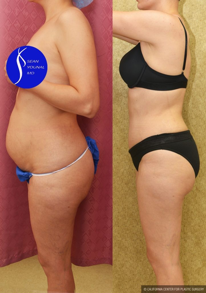 Tummy Tuck (Abdominoplasty) Small Size Before & After Patient #13878