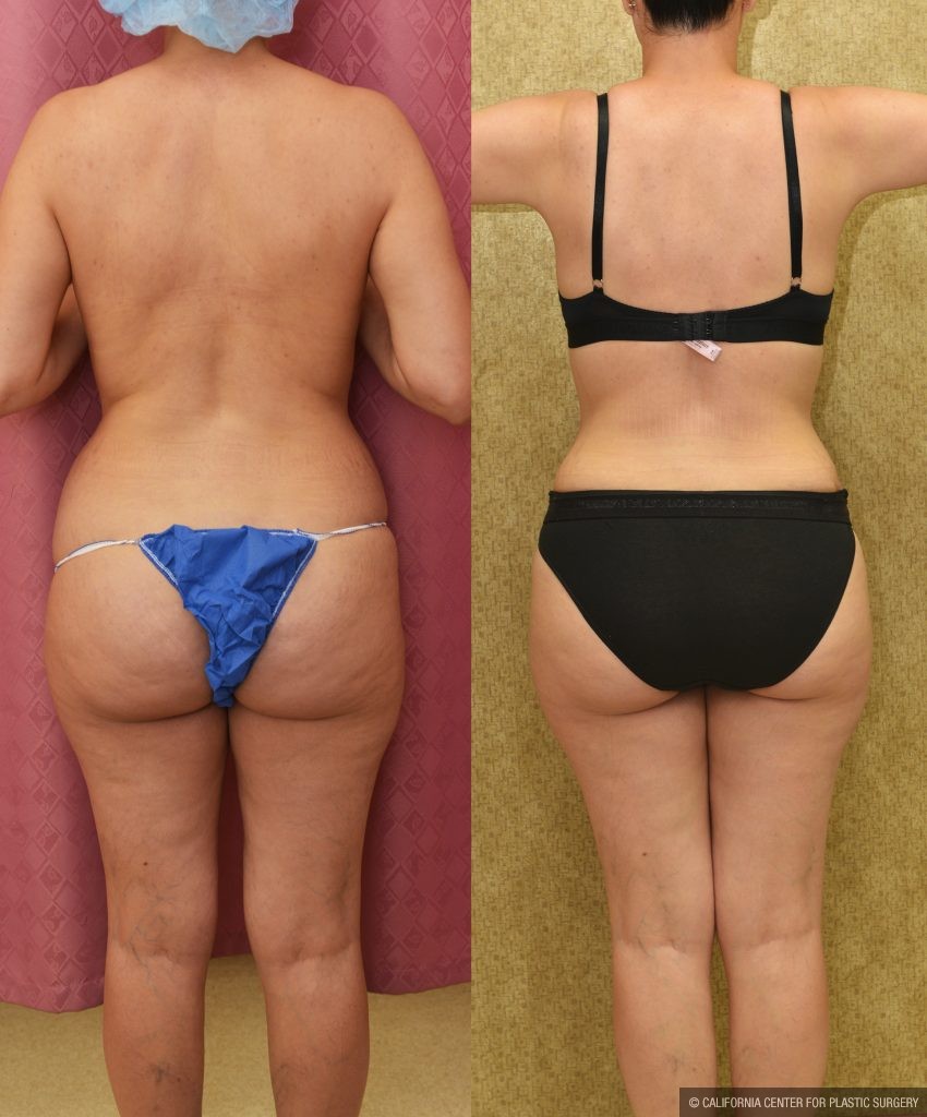 Tummy Tuck (Abdominoplasty) Small Size Before & After Patient #13878