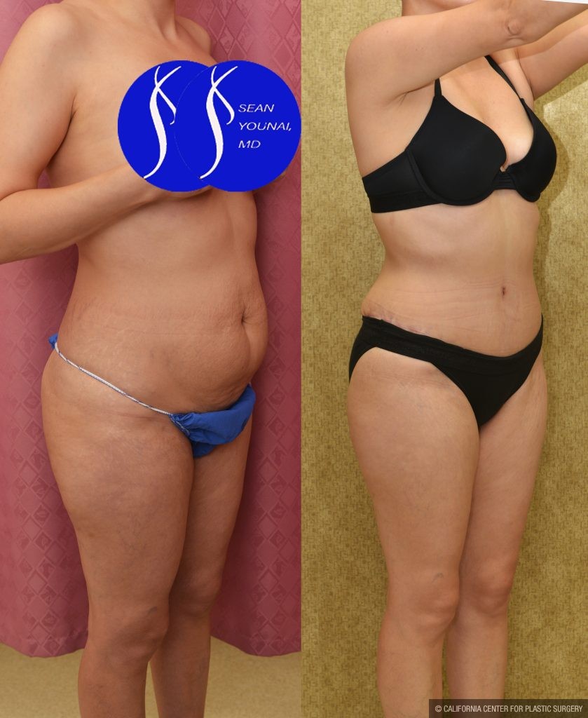 Tummy Tuck (Abdominoplasty) Small Size Before & After Patient #13878
