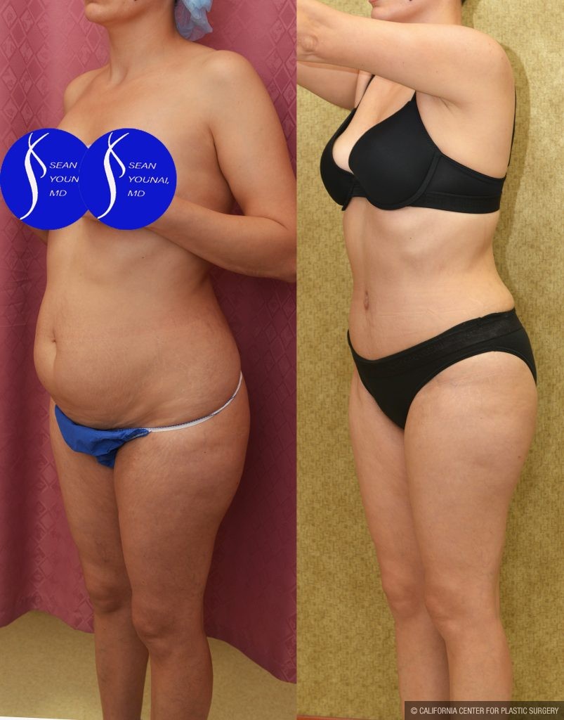 Tummy Tuck (Abdominoplasty) Small Size Before & After Patient #13878