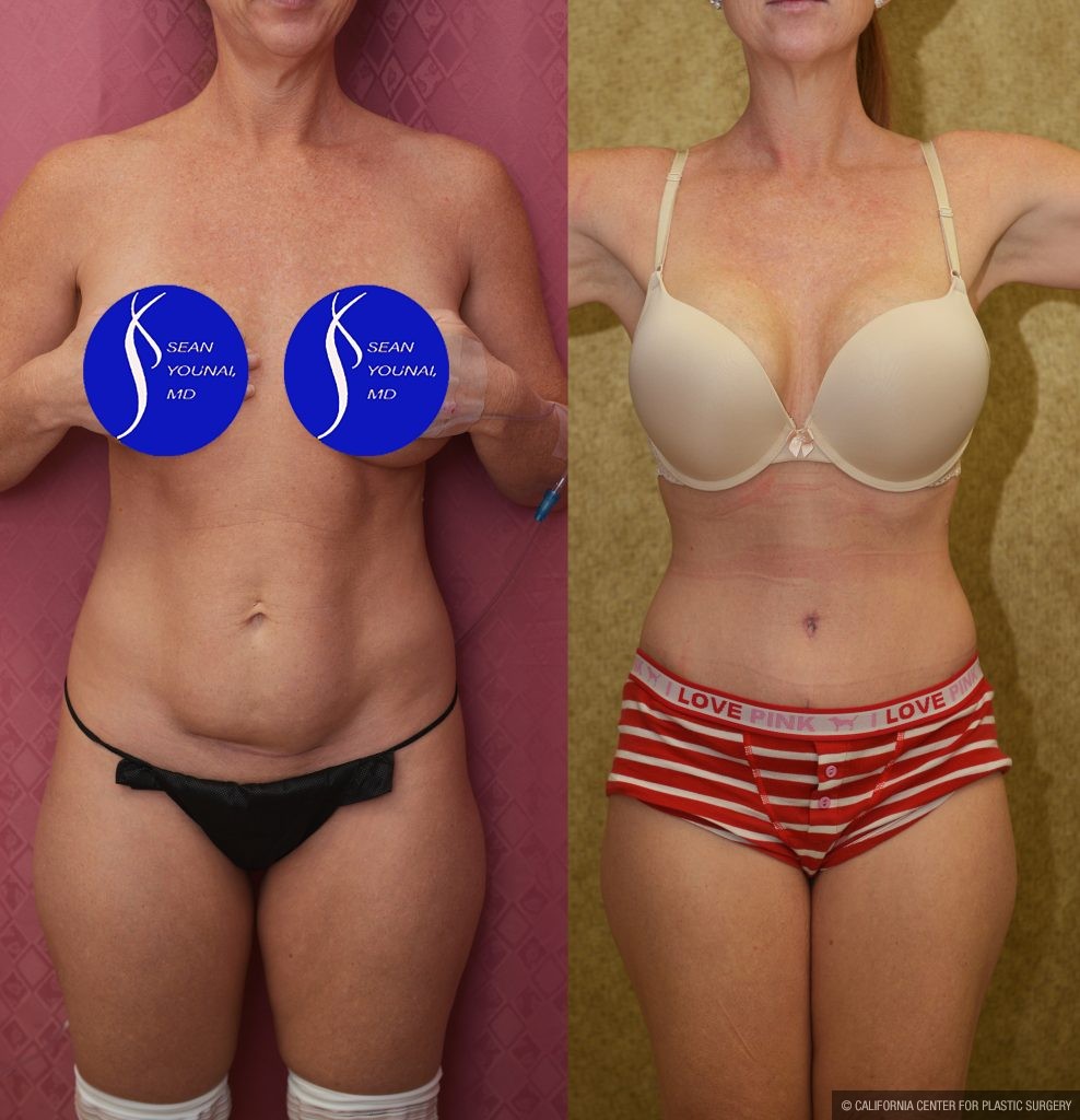 Tummy Tuck (Abdominoplasty) Small Size Before & After Patient #13879