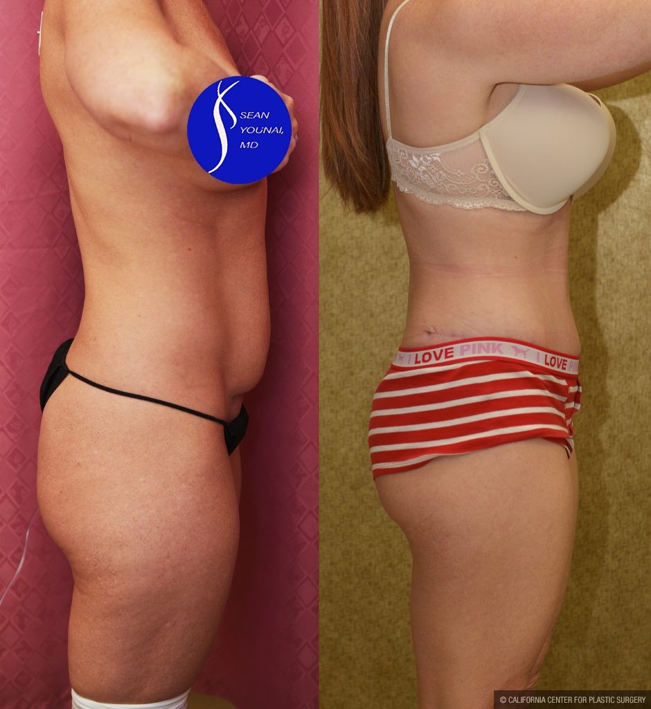 Tummy Tuck (Abdominoplasty) Small Size Before & After Patient #13879
