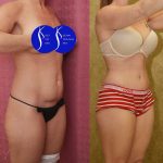 Tummy Tuck (Abdominoplasty) Small Size Before & After Patient #13879