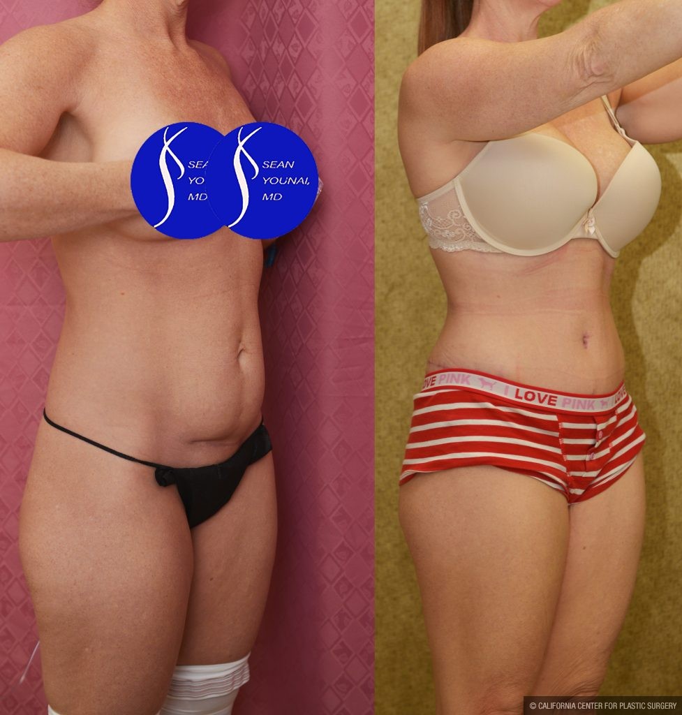 Tummy Tuck (Abdominoplasty) Small Size Before & After Patient #13879