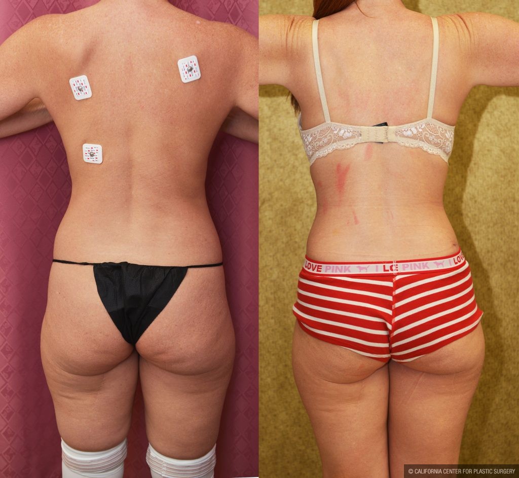 Tummy Tuck (Abdominoplasty) Small Size Before & After Patient #13879