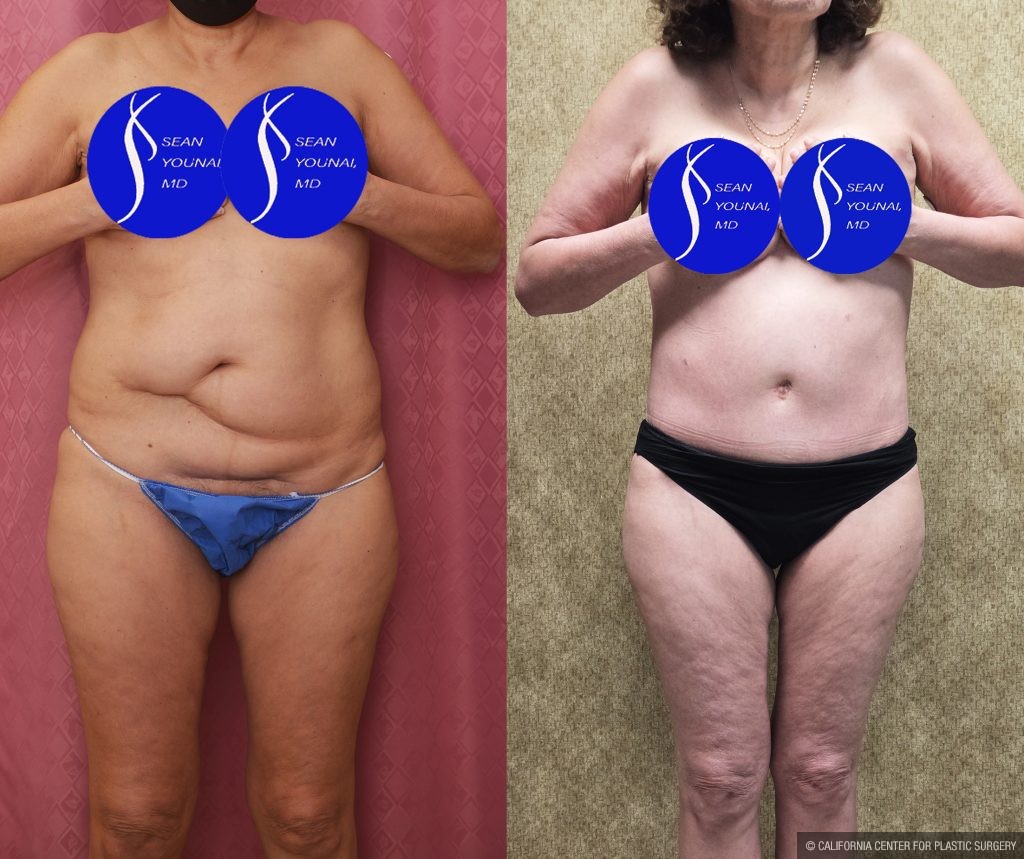 Tummy Tuck (Abdominoplasty) Small Size Before & After Patient #13880