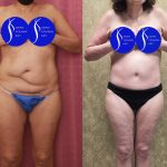 Tummy Tuck (Abdominoplasty) Small Size Before & After Patient #13880