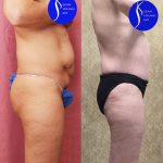 Tummy Tuck (Abdominoplasty) Small Size Before & After Patient #13880