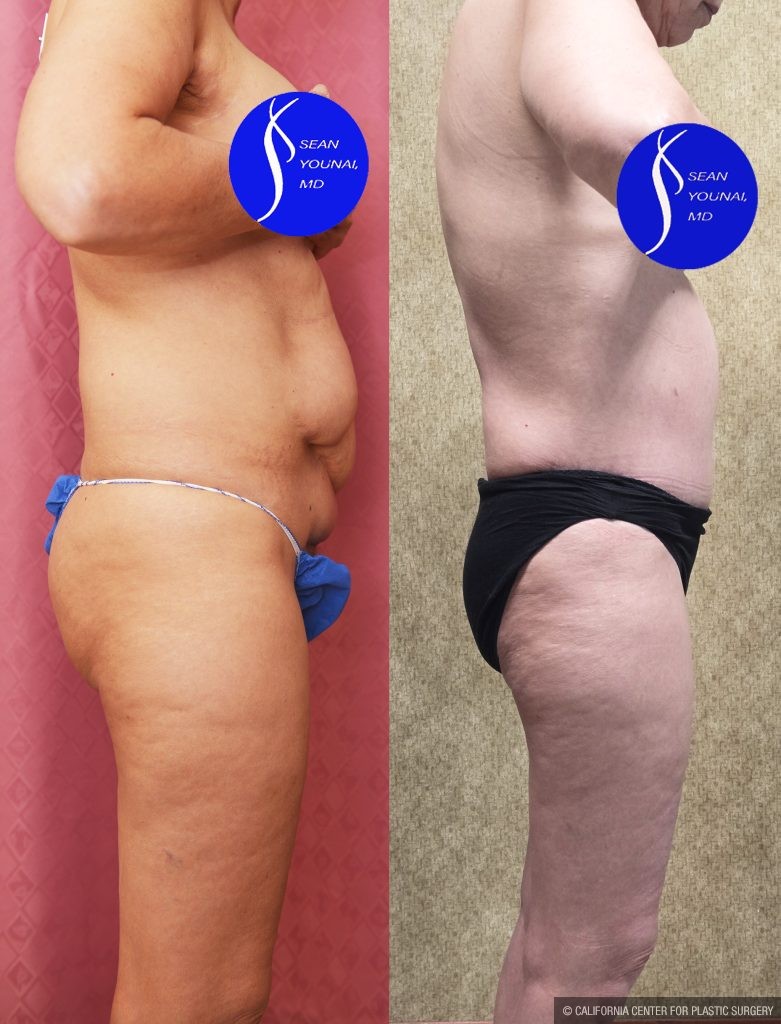 Tummy Tuck (Abdominoplasty) Small Size Before & After Patient #13880