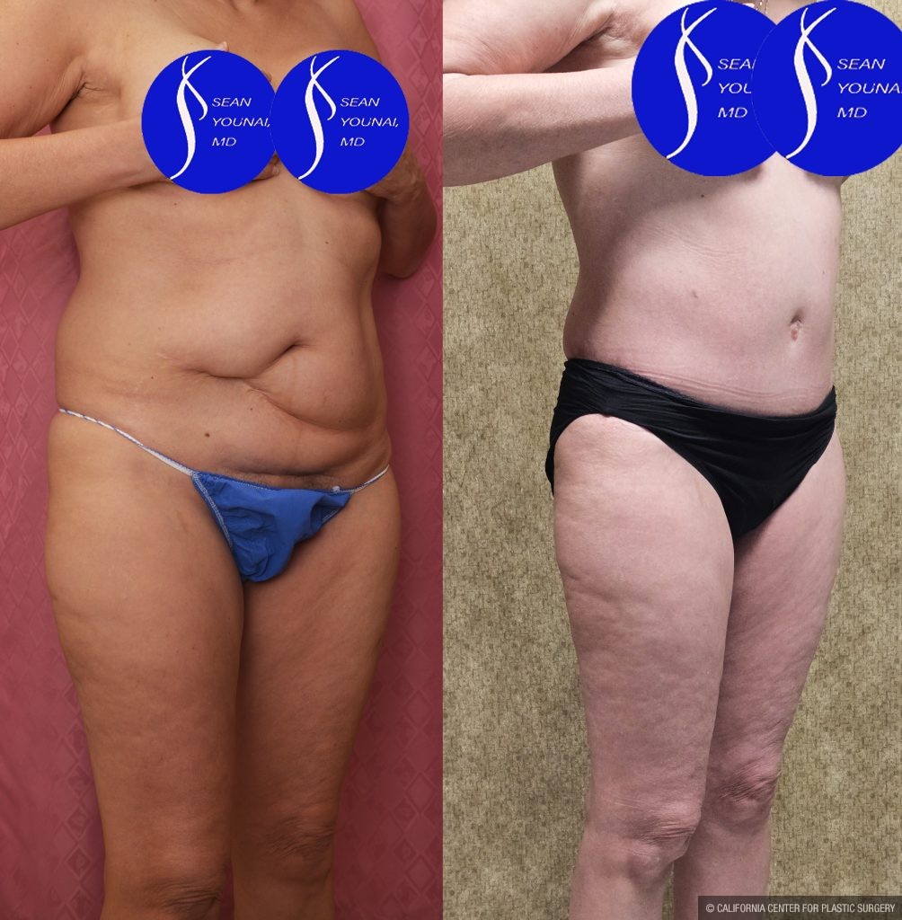 Tummy Tuck (Abdominoplasty) Small Size Before & After Patient #13880