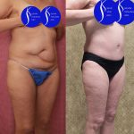 Tummy Tuck (Abdominoplasty) Small Size Before & After Patient #13880
