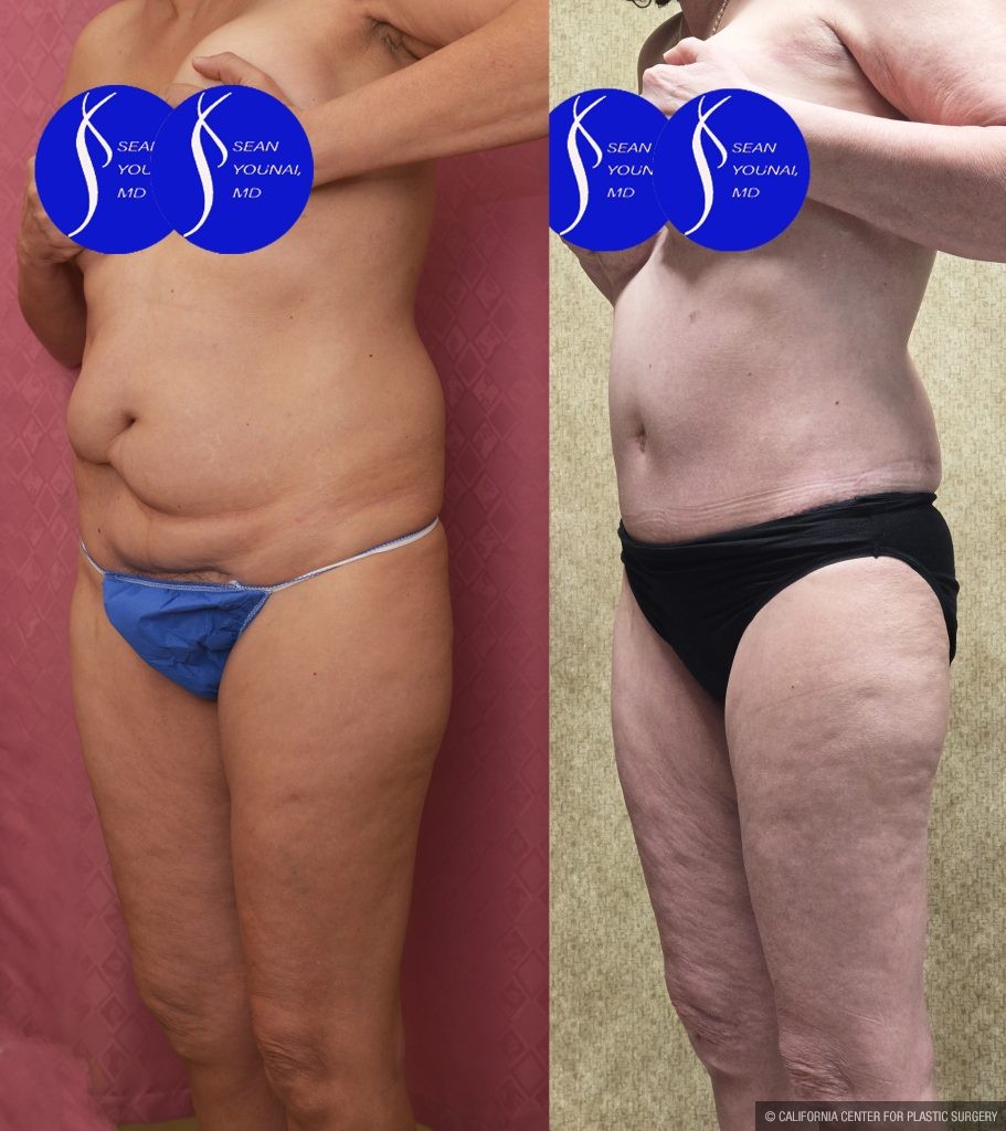 Tummy Tuck (Abdominoplasty) Small Size Before & After Patient #13880