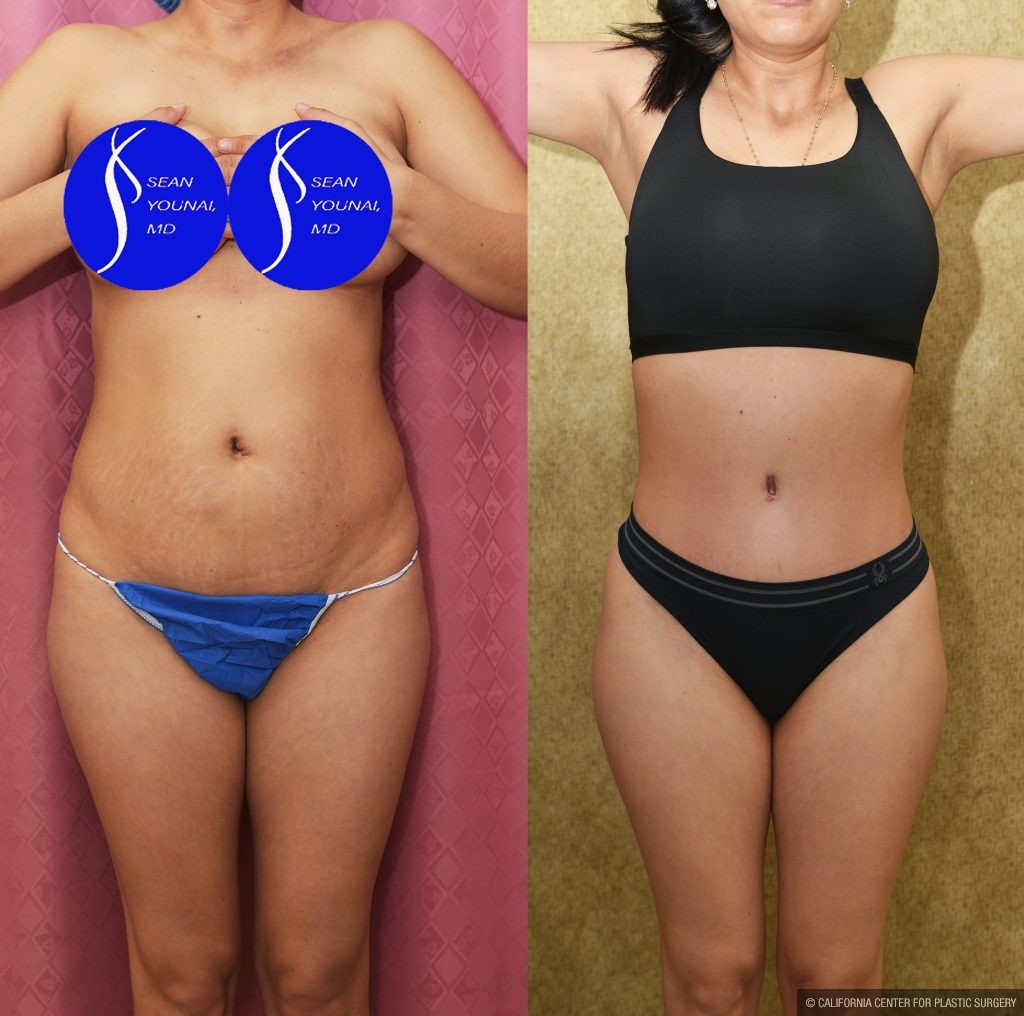 Tummy Tuck (Abdominoplasty) Small Size Before & After Patient #13881