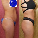 Tummy Tuck (Abdominoplasty) Small Size Before & After Patient #13881