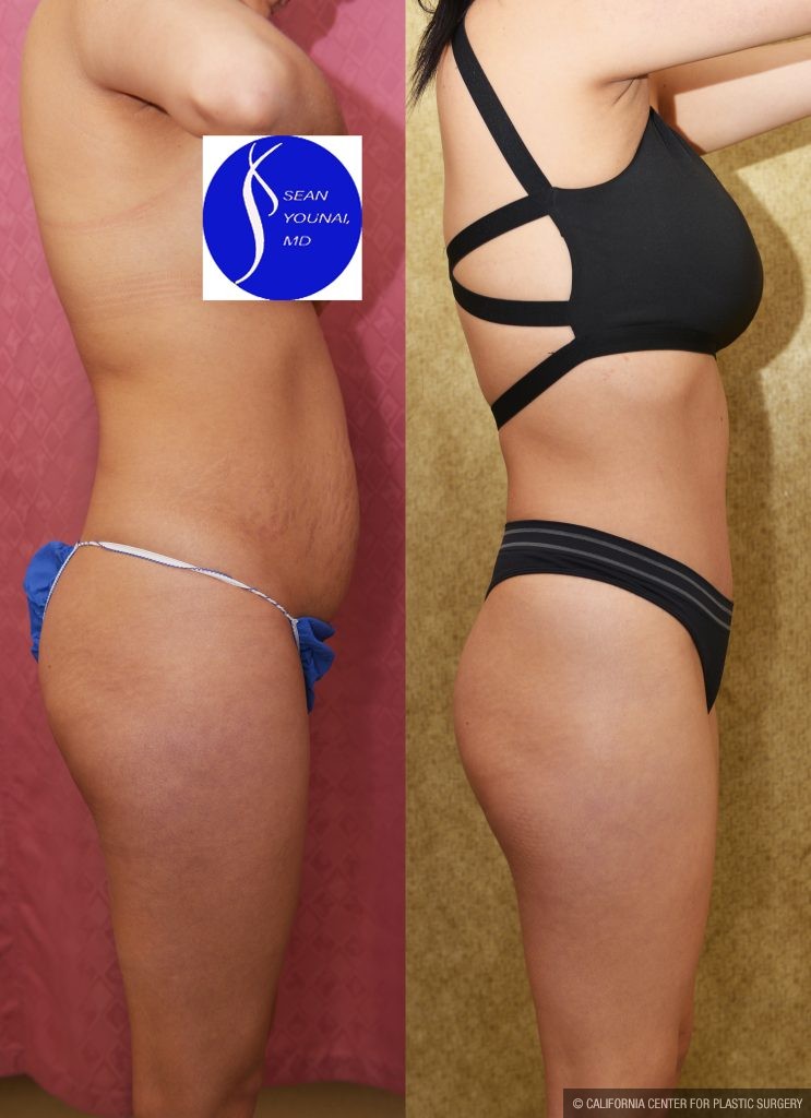 Tummy Tuck (Abdominoplasty) Small Size Before & After Patient #13881