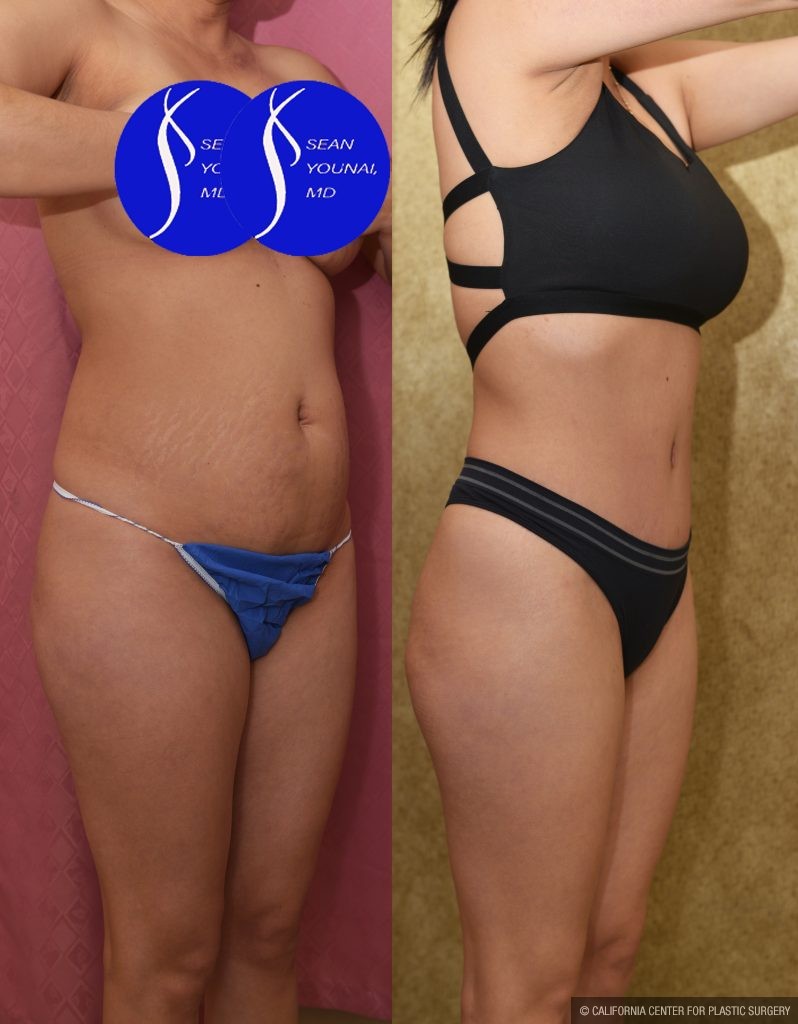 Tummy Tuck (Abdominoplasty) Small Size Before & After Patient #13881