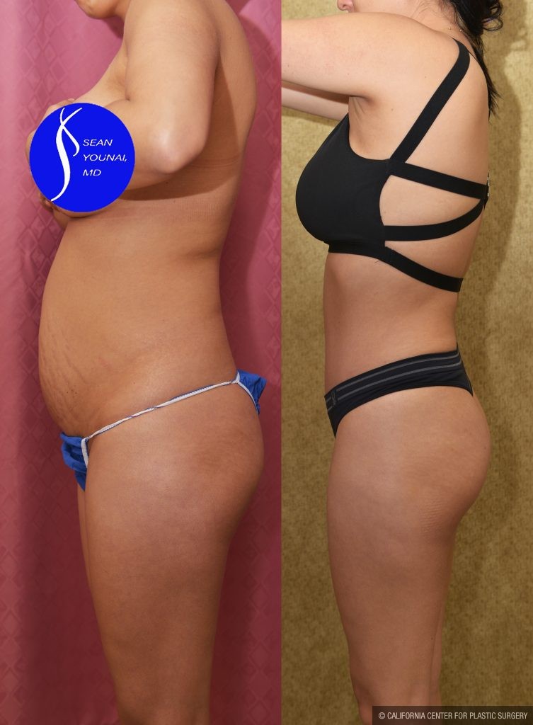 Tummy Tuck (Abdominoplasty) Small Size Before & After Patient #13881