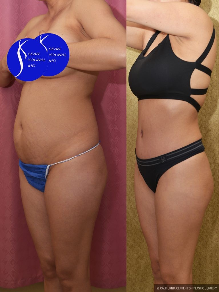 Tummy Tuck (Abdominoplasty) Small Size Before & After Patient #13881