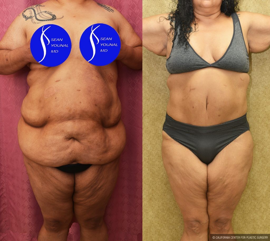 Tummy Tuck (Abdominoplasty) Super Plus Size Before & After Patient #13964