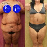 Tummy Tuck (Abdominoplasty) Super Plus Size Before & After Patient #13964