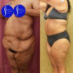 Tummy Tuck (Abdominoplasty) Super Plus Size Before & After Patient #13964