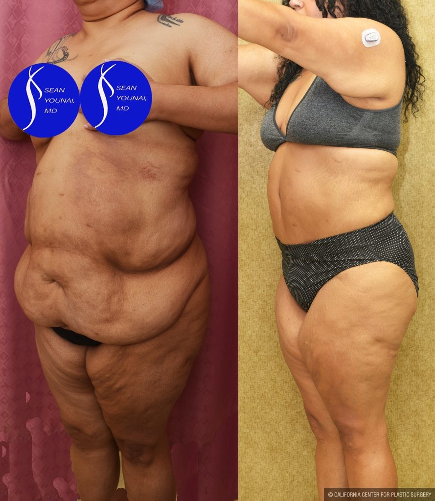 Tummy Tuck (Abdominoplasty) Super Plus Size Before & After Patient #13964