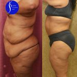 Tummy Tuck (Abdominoplasty) Super Plus Size Before & After Patient #13964