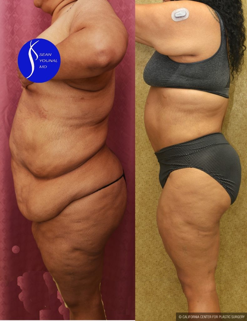 Tummy Tuck (Abdominoplasty) Super Plus Size Before & After Patient #13964