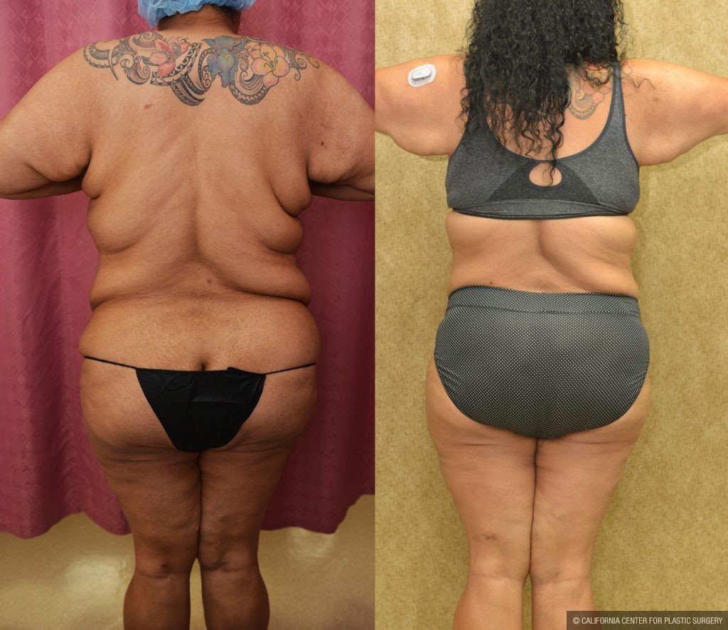 Tummy Tuck (Abdominoplasty) Super Plus Size Before & After Patient #13964