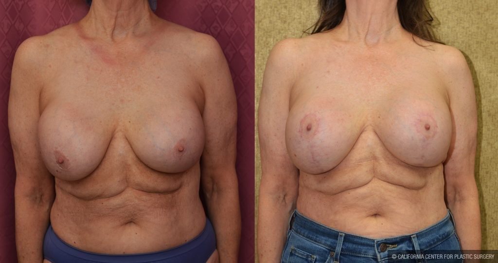 Breast Augmentation (Revision) Before & After Patient #13870