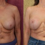 Breast Augmentation (Revision) Before & After Patient #13870