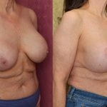 Breast Augmentation (Revision) Before & After Patient #13870