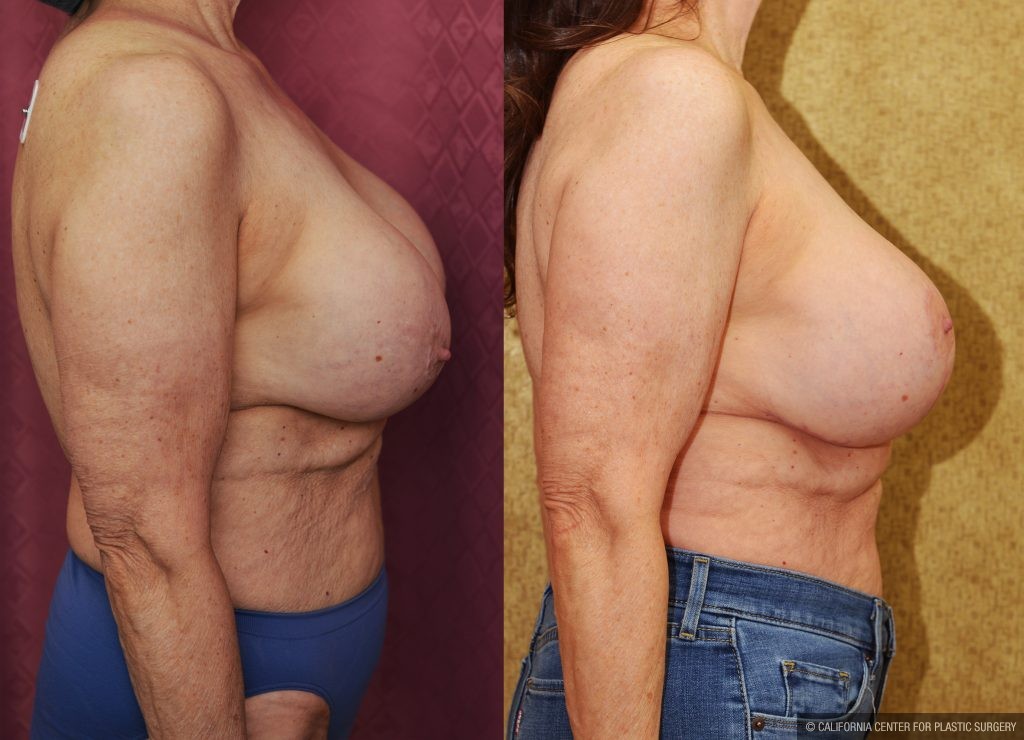 Breast Augmentation (Revision) Before & After Patient #13870