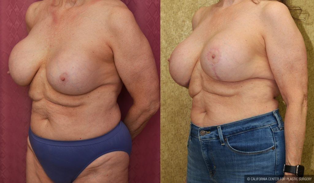 Breast Augmentation (Revision) Before & After Patient #13870