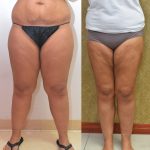 Thigh Lift Before & After Patient #13872